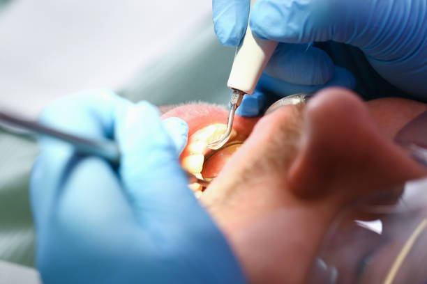 Best Emergency Tooth Extraction in Lake Ridge, VA